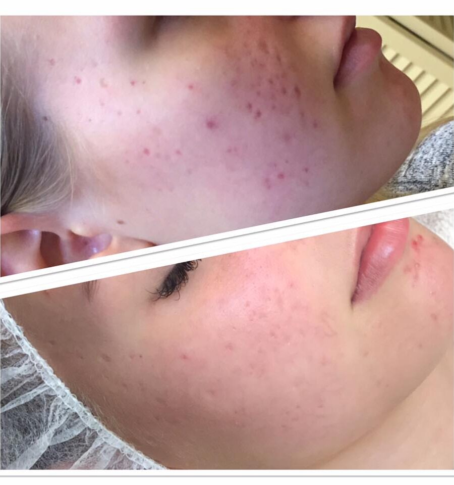 Dermapen 4 Mikroneulaus
